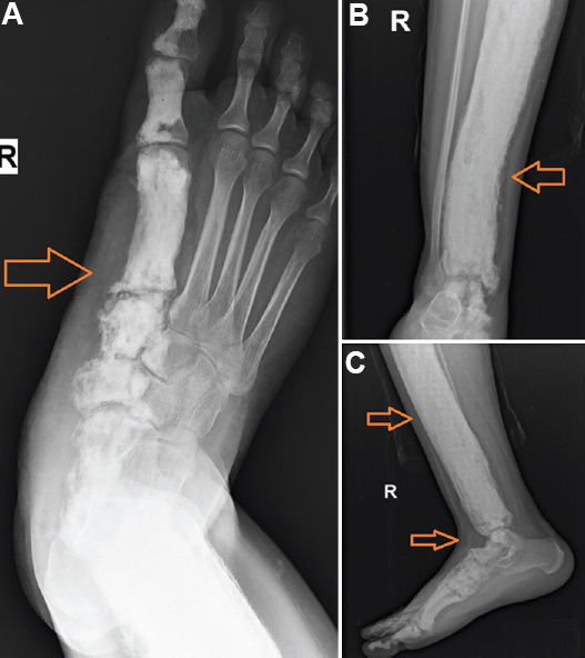 Plain radiographs showing multi-osseous involvement of the (A) foot, (B) ankle, and (C) leg, bones, with cortical thickening, bone expansion and dripping candle wax appearance (arrows).